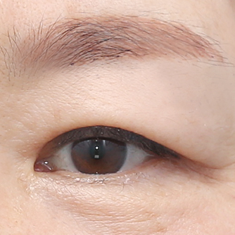 Under-brow resection
