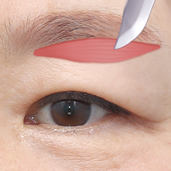 Under-brow resection