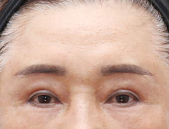 Forehead lift (Endoscopic eyebrow lifting)